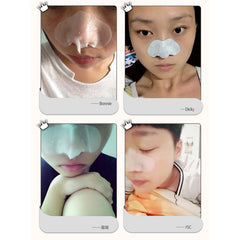 12Pcs atwargi Face Care Nose Mask Remove Blackhead Acne Remover  3 Step Kit