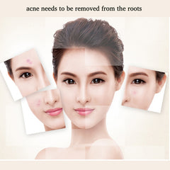 Face Acne Cream Acne Scar treatment Anti Acne Cleaning Pimple quickly Face Cream