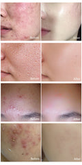 Face Acne Cream Acne Scar treatment Anti Acne Cleaning Pimple quickly Face Cream